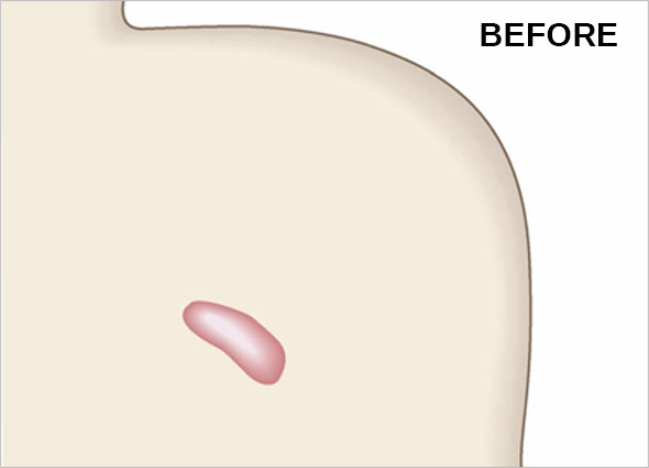 Keloid Scar Treatment & Removal