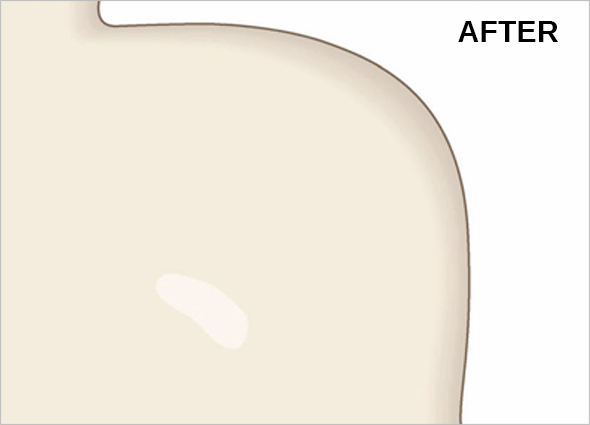 Keloid Scar Treatment & Removal