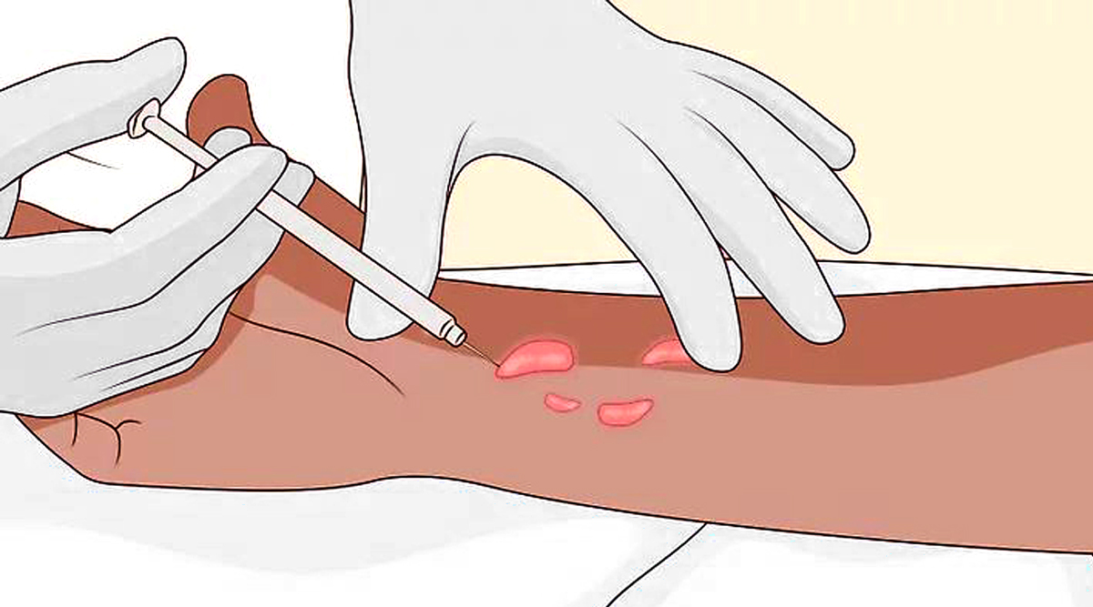 Keloid Scar Treatment & Removal