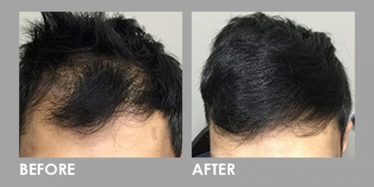 Before & After LED Photomodulation Therapy