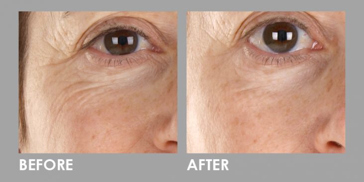 Before & After LED Photomodulation Therapy