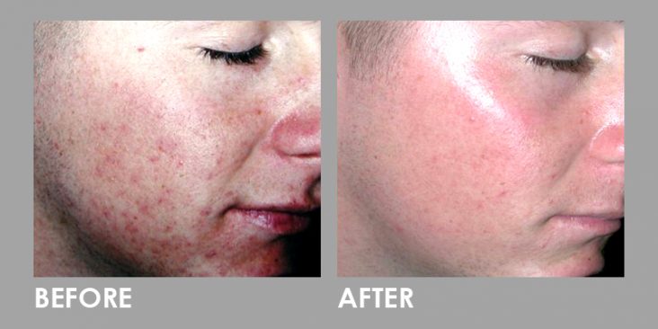 Before & After LED Photomodulation Therapy