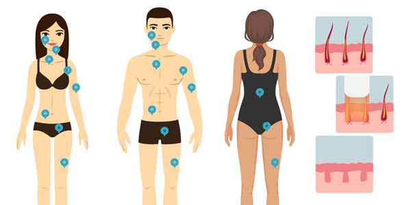 Laser Hair Removal Treatment Area