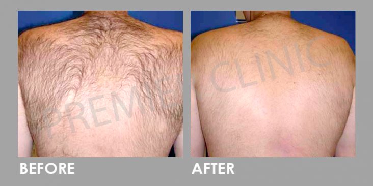 Before & After Candela Gentle YAG Laser Treatment