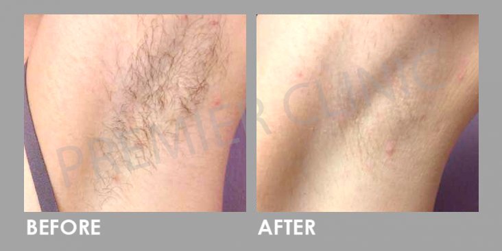 Before & After Candela Gentle YAG Laser Treatment