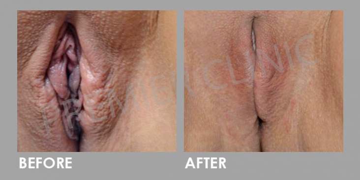 Laser-Vaginal-Rejuvenation