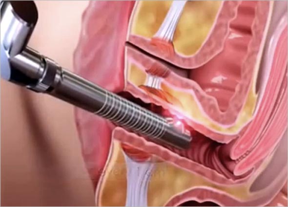 FILLER INJECTIONS FOR VAGINAL REJUVENATION