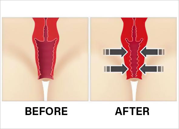 FILLER INJECTIONS FOR VAGINAL REJUVENATION