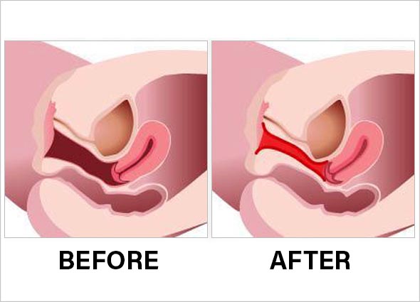 FILLER INJECTIONS FOR VAGINAL REJUVENATION