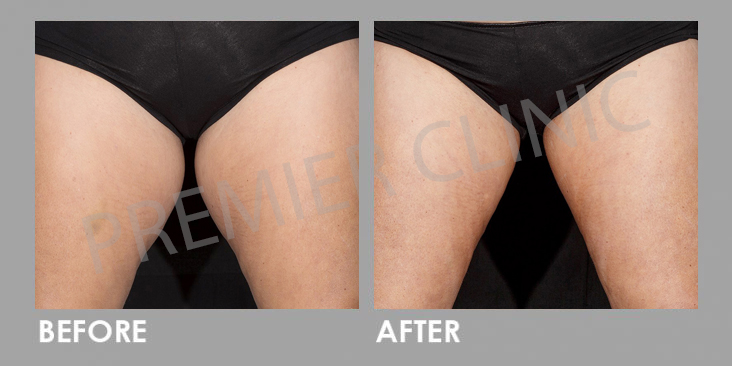 Before & After Le Shape: Weight Loss Body Slimming
