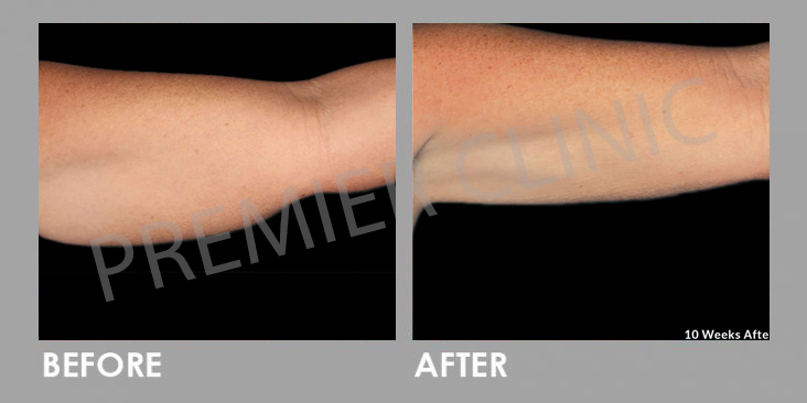 Before & After Le Shape: Weight Loss Body Slimming