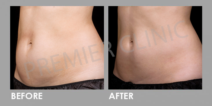 Before & After Le Shape: Weight Loss Body Slimming