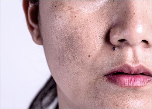 Melasma