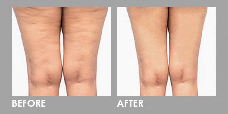 Mesolipo Fat Melting Slimming Injection