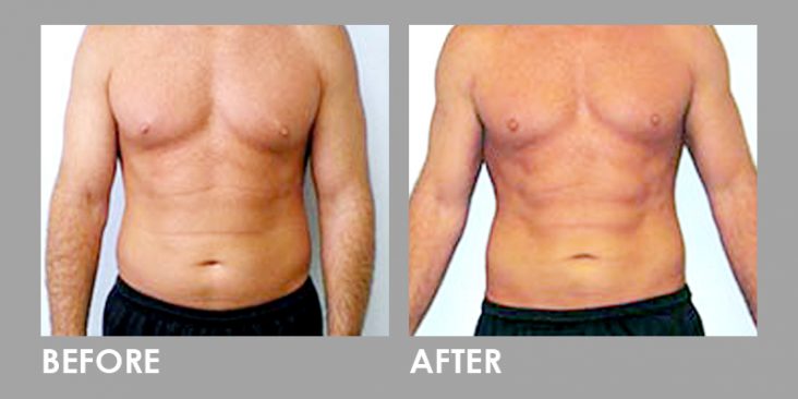Mesolipo Fat Melting Slimming Injection