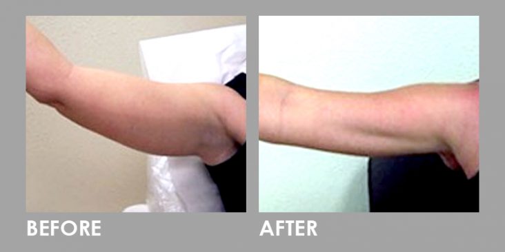 Mesolipo Fat Melting Slimming Injection