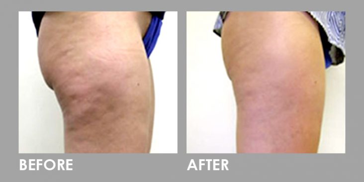 Mesolipo Fat Melting Slimming Injection