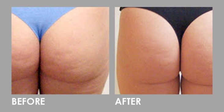 Mesolipo Fat Melting Slimming Injection