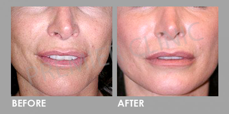 Before & After Mesotherapy