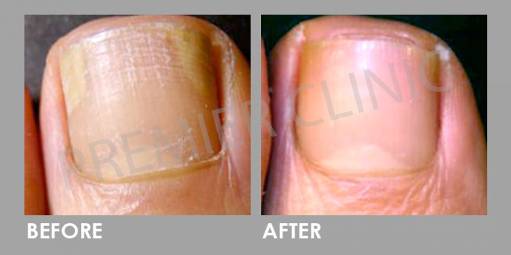 Before & After Nail Fungal Infection Laser