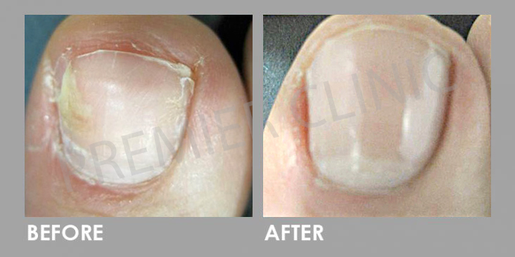 Before & After Nail Fungal Infection Laser