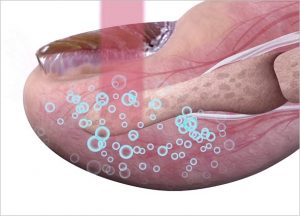 Nail Fungal Infection Laser 