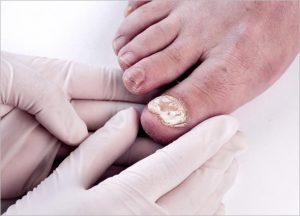 Nail Fungal Infection Laser 