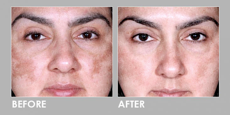 Before & After Obagi Medical Grade Skincare