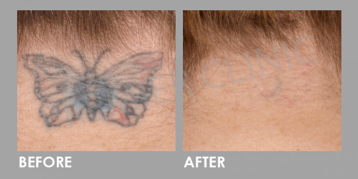 Before & After PICO Laser