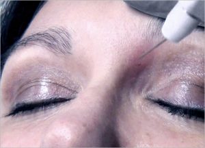 PLEXR PLASMA SOFT SURGERY