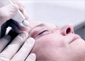 PLEXR PLASMA SOFT SURGERY