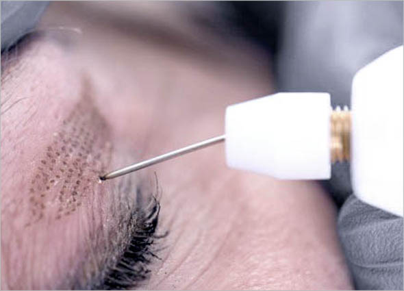 PLEXR PLASMA SOFT SURGERY