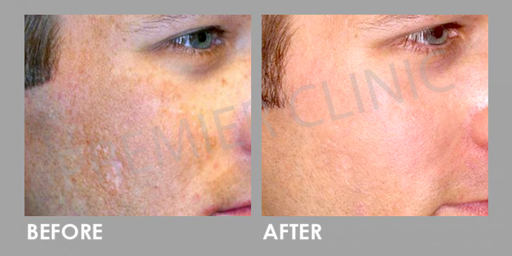 Platelet-rich Plasma (PRP)