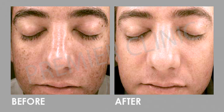 Platelet-rich Plasma (PRP)