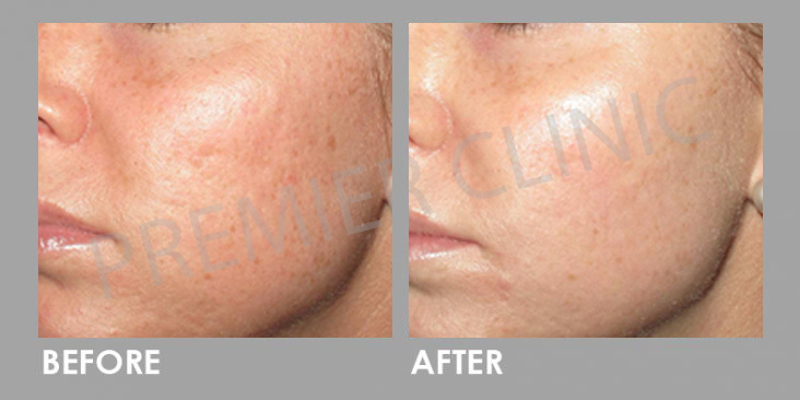 Before & After Carbon Laser Peel Treatment