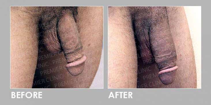 Before & After Penis Enlargement Treatment