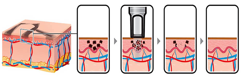 HOW DOES PICO LASER WORKS?