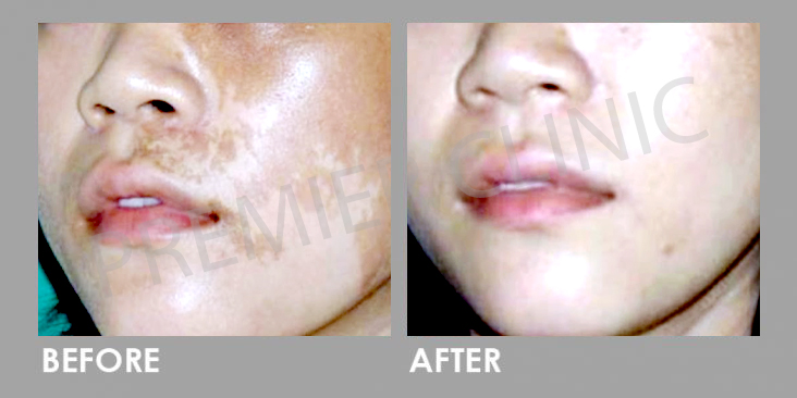 Before & After Q-Switch Nd:YAG Laser