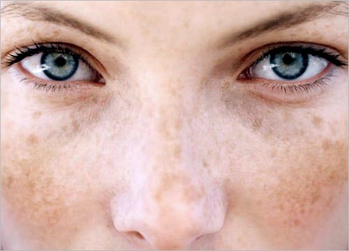 Pigmentation/Age spot