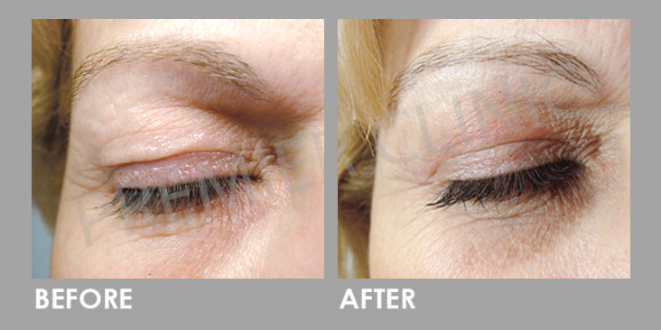 Plexr Plasma Soft Surgery
