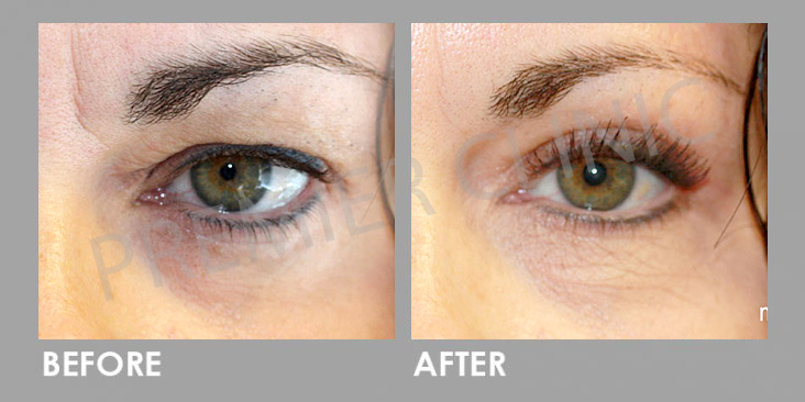 Plexr Plasma Soft Surgery