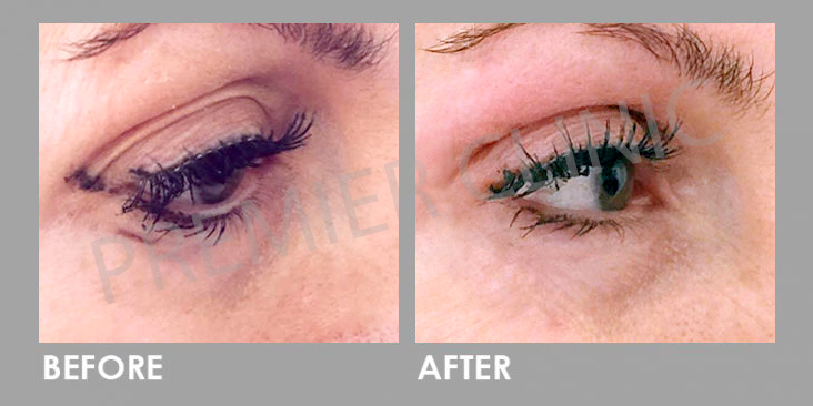 Plexr Plasma Soft Surgery
