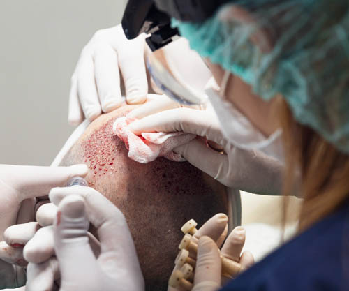 Premier FUE Hair Transplant - High Graft Survival Rate