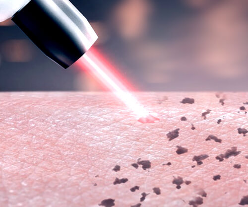 Premier Pico Laser - More Effective