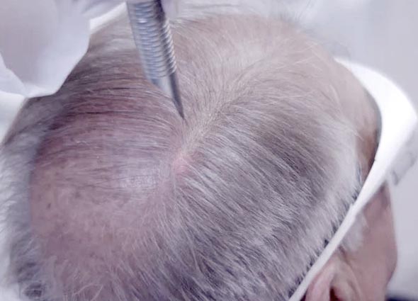 Premier Signature Hair Growth Laser Treatment
