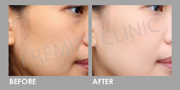 Before & After Crystal Tomato Supplement