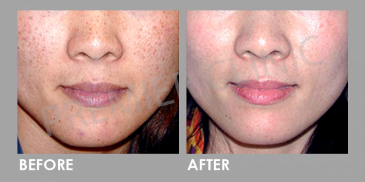 Before & After Crystal Tomato Supplement
