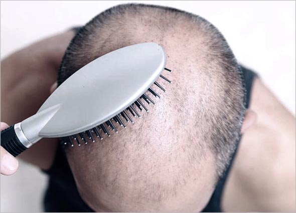 Regro (Minoxidil) Spray