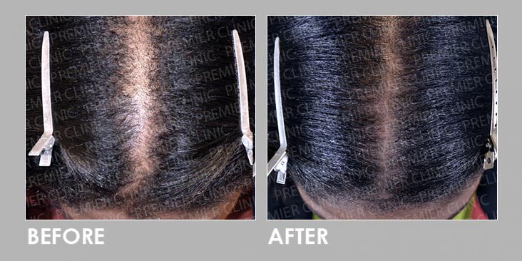 Before & After Finasteride Oral & Regro Spray