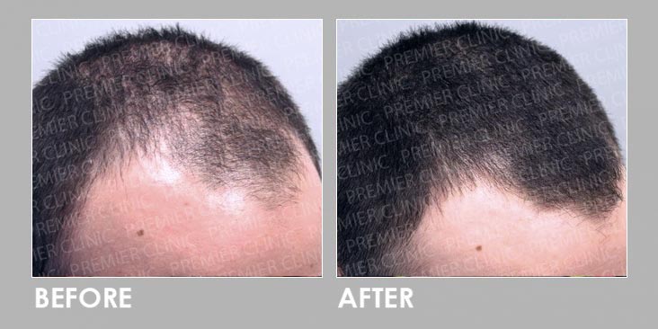 Before & After Finasteride Oral & Regro Spray